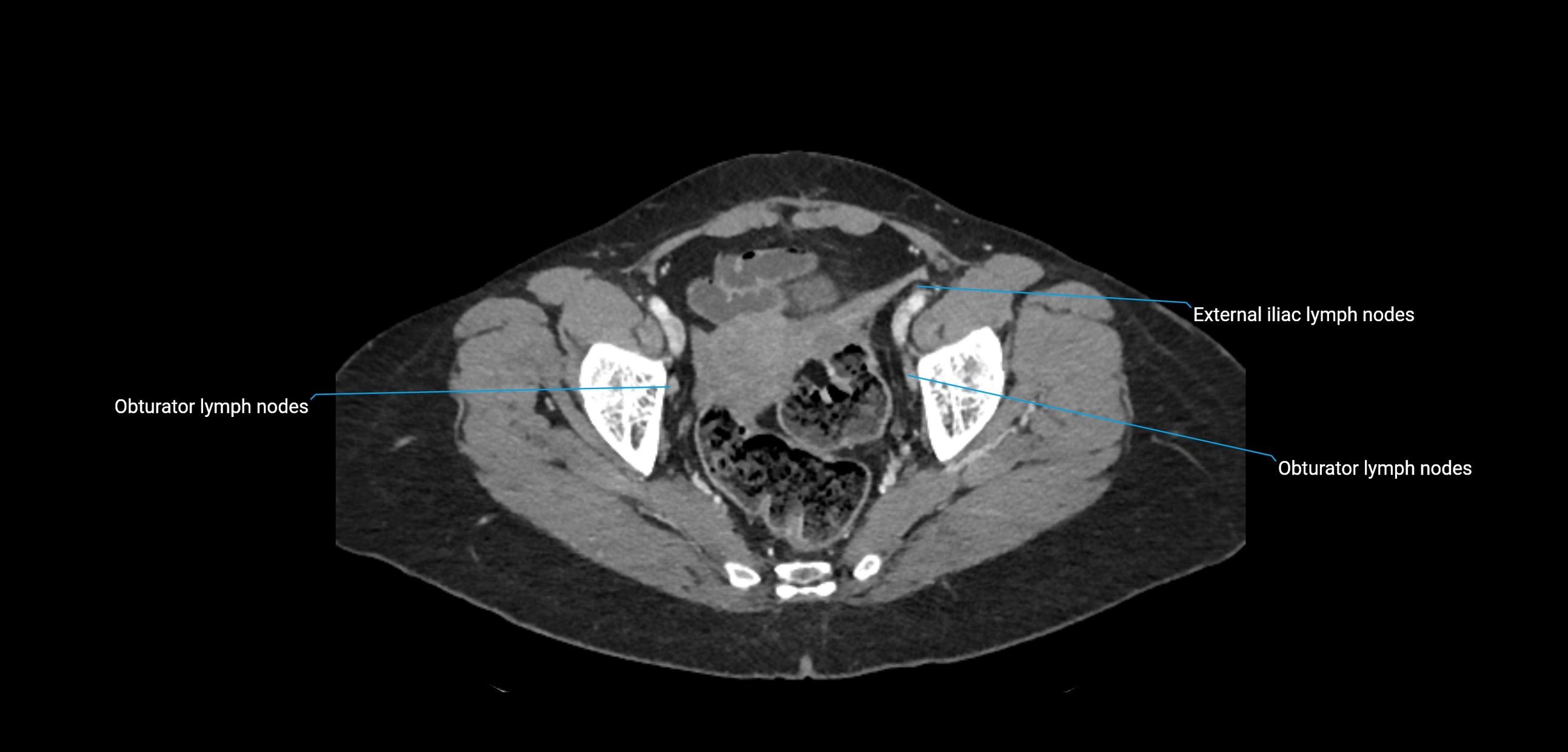 CT ct abdominal lymph nodes  axial cross sectional anatomy  enchanced radiology image -img-00002-00367.webp